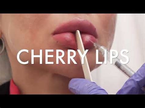 cherry lip injections.